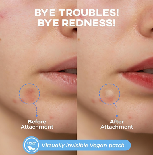 Nolahour - Acne patch, Spot Eraser Blue Step2